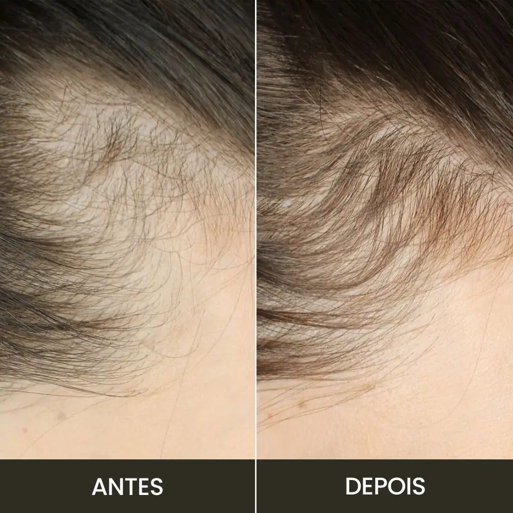Escova de Terapia Capilar à Laser: TheraBrush Smarts 4 em 1 - Tratamento Capilar e Antiqueda